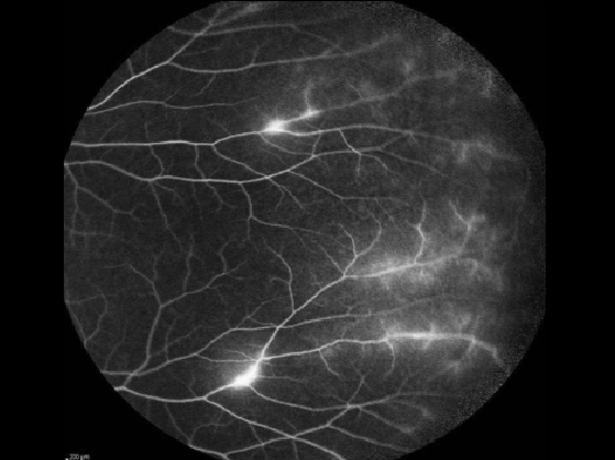 Vasculitis retiniana – angiografía