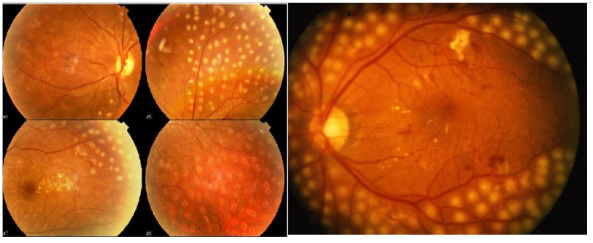 Retinografía con drusas maculares DMAE