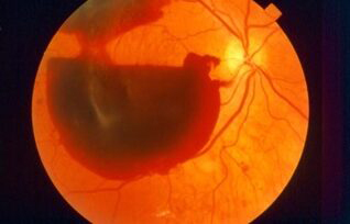 Retinografía de desprendimiento de retina