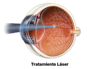 Ilustración fotocoagulación con láser