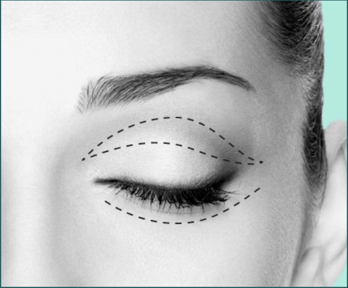 Oculoplastía y Vías Lagrimales — Instituto Santa Lucía Paraná