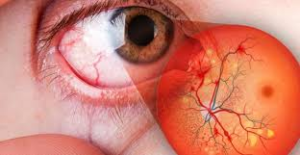 Novedades retinopatia 3